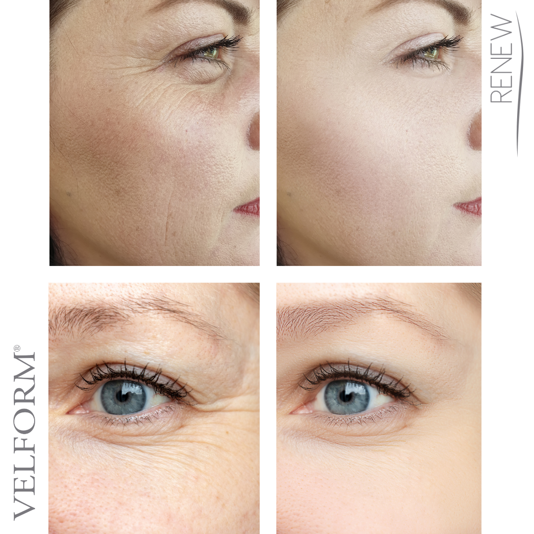 Tratamiento Facial Antiaging Colágeno Ácido Hialuronico – imagen 5